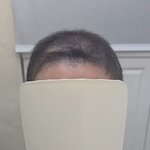 [피부미용] 항암<b>가발</b> 준비시기야 혹 가족중 환우분이 계시면 참고해