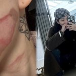 AOA 출신 권민아, 의료사고 <b>고백</b>…리프팅 시술 중 얼굴 10%...