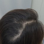 [피부미용] 여자인모가발 착용했는데 티나나??