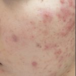 [드루와] (사진주의) 8년 지성<b>모태</b>여드름피부 나아진 방법 공유할게...