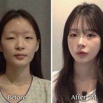 [댓글부탁해] 성형효과 개쩐다