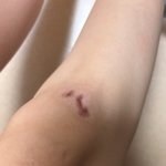 [댓글부탁해] 다리 흉터때문에 우울해(<b>사진</b> 봐주라)