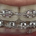 [댓글부탁해] 교정기 4년차 <b>교정</b>이 왜 안끝나지