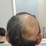 불의의 사고로 흉터가발 시술 해드린 후기 by. 맞춤<b>가발</b>