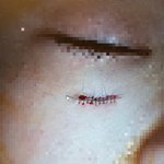 <b>초등학교</b> 입학하자마자 얼굴에 연필찔림사고