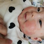 우리 아들 <b>아토피</b> 좋아지고 리즈 갱신중..!!!!