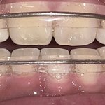 [드루와] 교정 유지<b>장치</b> 이거 잘 끼는 사람들