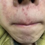 이런 뾰루지 <b>자주</b> 나는사람