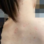 (여드름 사진 있음)내친구가 <b>사람</b>이면 이정도 등드름은 다 있다는데...