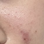 이런건 피부과가 <b>답</b>인가ㅜㅜ