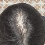 [댓글부탁해] 고2 여학생 <b>탈모</b>