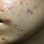 피부 뒤집어지는 사람들 이거 진짜 한번만 봐라;;