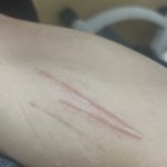 풀리오 V3 종아리 마사지기 쓰고 화상 같은 증상 생겼어요 (사진...