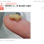 <b>양치</b>하다 ㅈㄴ 큰 편도결석 나왔다