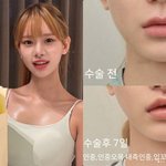 맹승지, 인중축소+입꼬리 성형 <b>전후</b> 비교…"인중 짧아져 더 어려보여"...