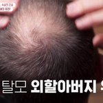 외할아버지가 탈모면 높은확률로 손자도 탈모라는 <b>전문가</b>...jpg