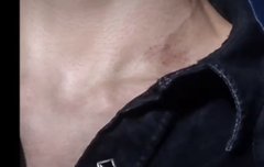 제노 목에 키스마크