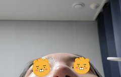 코성형1년차