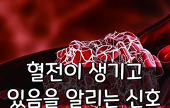 [좋은글] 혈전이 생기고 있음을 알리는 신호