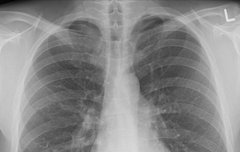 [좋은글] 폐암의 원인과 예방법