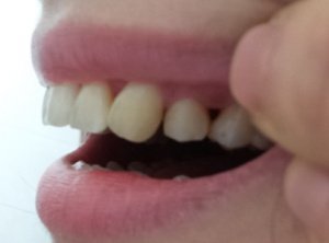 추가)2년3개월만에 끝난 치아교정이 이 모양 이꼴입니다. | 네이트 판