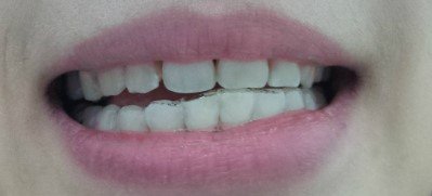 추가)2년3개월만에 끝난 치아교정이 이 모양 이꼴입니다. | 네이트 판