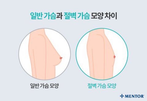 사진 왼쪽이랑 가슴 똑같은데 | 네이트 판