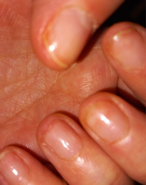 손톱이아주다른사람처럼변하기도하나요