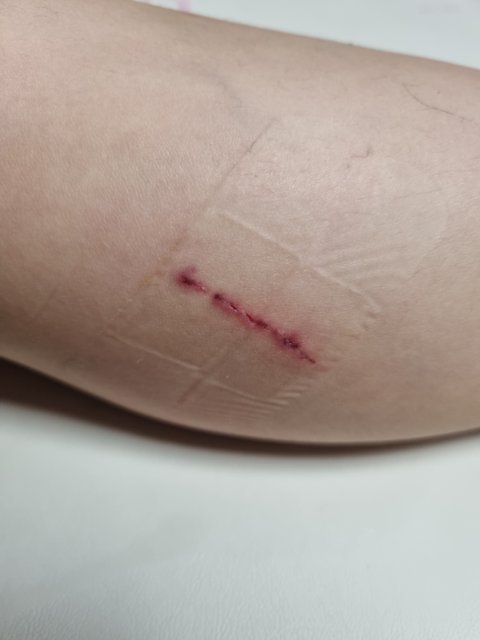 롤러스케이트장 침핀 사고, 개인과실인가요?