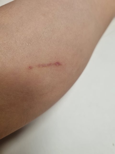 롤러스케이트장 침핀 사고, 개인과실인가요?