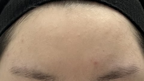 피부 약한 애들 페이스왁싱 받지 마..사진있음