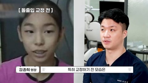 치아교정으로 얼굴 달라진 연예인들