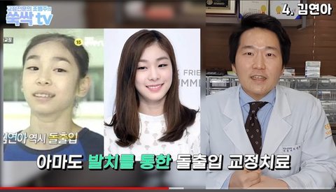 치아교정으로 얼굴 달라진 연예인들