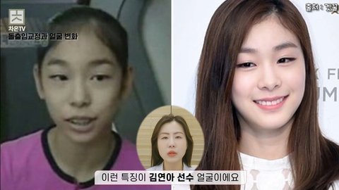 치아교정으로 얼굴 달라진 연예인들