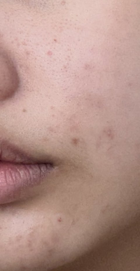 한달동안 피부 뒤집어진거 복구함