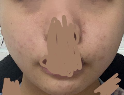 한달동안 피부 뒤집어진거 복구함