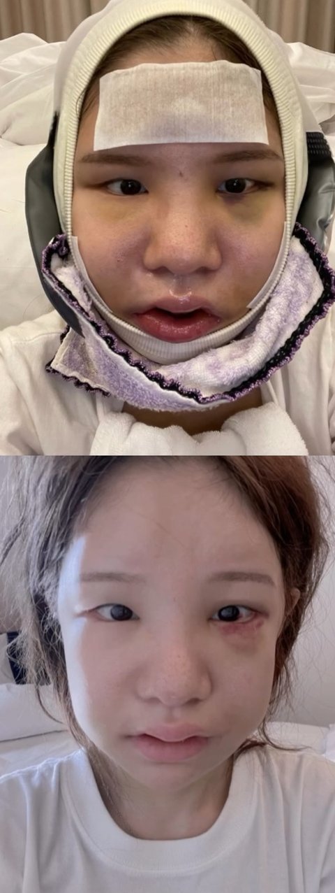 최근 성형전후 레전드